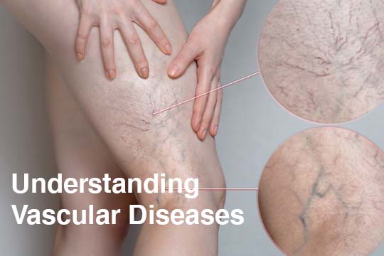 Understanding the vascular disease